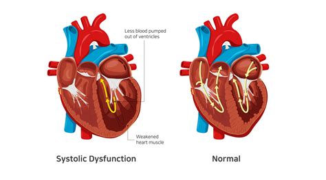 what is lv systolic dysfunction.